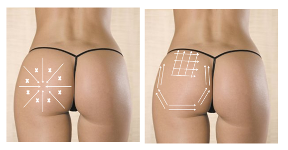 Zaawansowany cellulit  <?echo $add_image;?>