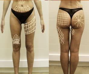 Zaawansowany cellulit  <?echo $add_image;?>