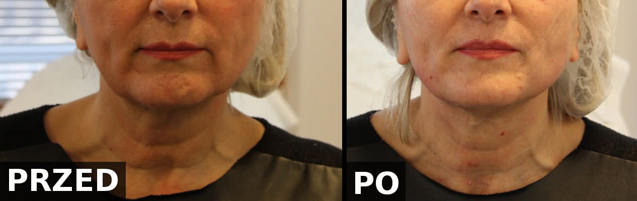 Porównanie efektów przed i bezpośrednio po zabiegu wprowadzenia nici PDO w okolicy żuchwy i szyi. <?echo $add_image;?>