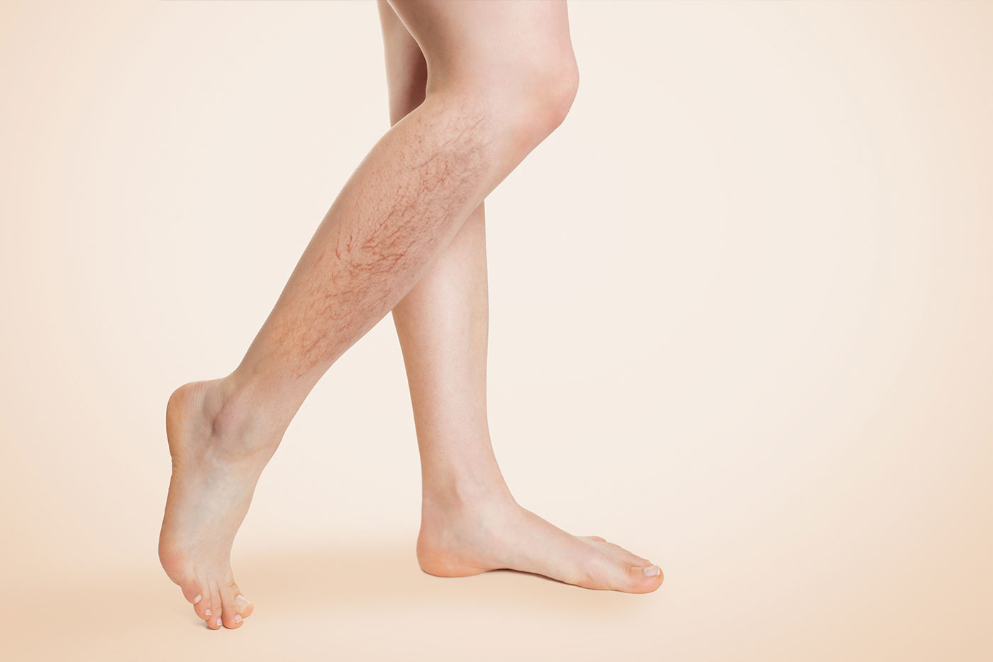 igła z nicią PDO PerfectLift Robert Janczura Medycyna Estetyczna Kraków Kielce Aqualyx, Nici BARB 4D, Laser CO2, VPL, Cosmelan, powiększanie ust, botox, botoks, makijaż permanentny, kwas hialuronowy, wypełniacze, mezoterapia, lifting twarzy