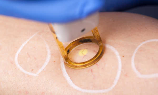 Technika zabiegu intralipoterapii(1)  PerfectLift Robert Janczura Medycyna Estetyczna Kraków Kielce Aqualyx, Nici BARB 4D, Laser CO2, VPL, Cosmelan, powiększanie ust, botox, botoks, makijaż permanentny, kwas hialuronowy, wypełniacze, mezoterapia, lifting twarzy