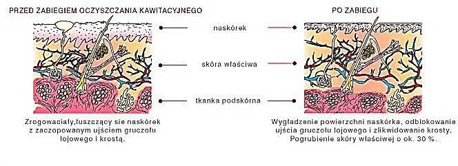 działanie peeling kawitacyjny zasada PerfectLift Robert Janczura Medycyna Estetyczna Kraków Kielce Aqualyx, Nici BARB 4D, Laser CO2, VPL, Cosmelan, powiększanie ust, botox, botoks, makijaż permanentny, kwas hialuronowy, wypełniacze, mezoterapia, lifting twarzy